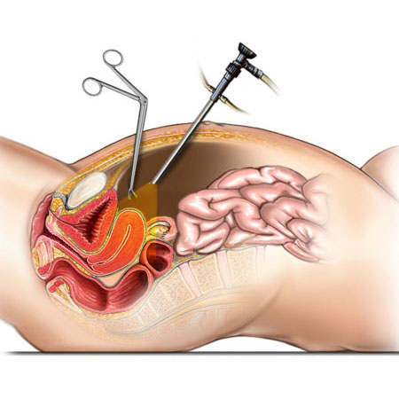 Endoscopic Surgery in Kanhangad