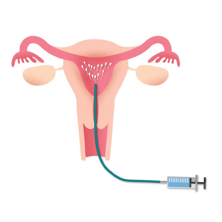 Frozen Embryo Transfer in Kanhangad