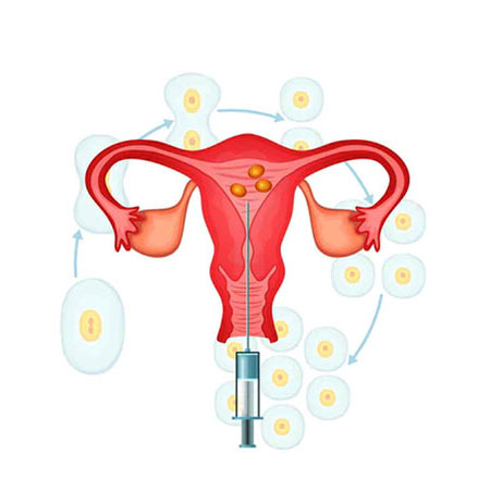 IUI Treatment in Kanhangad