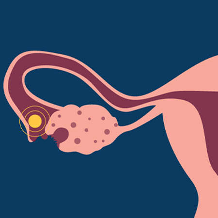 Ovulation Induction Treatment in Kanhangad