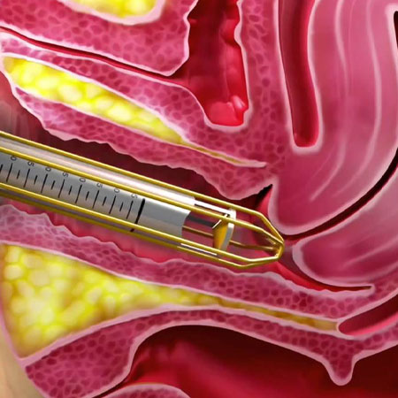 Vaginal Rejuvenation in Kanhangad